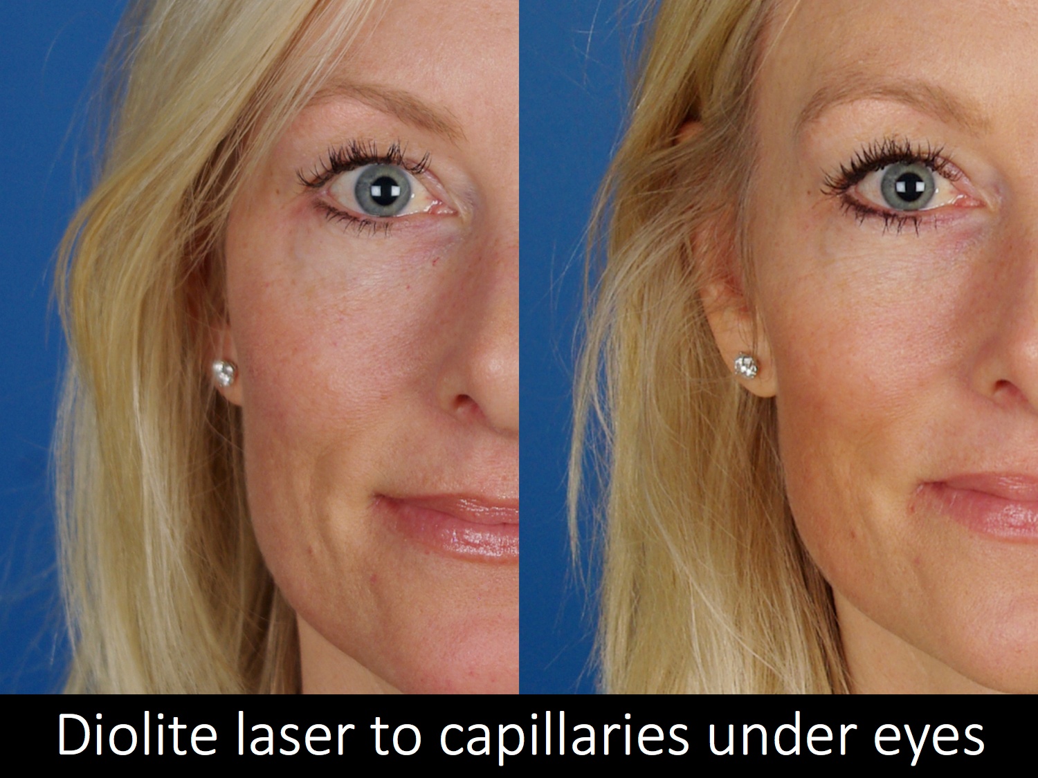 Laser Skin Treatments Before & Afters Raval Facial Aesthetics RMLA